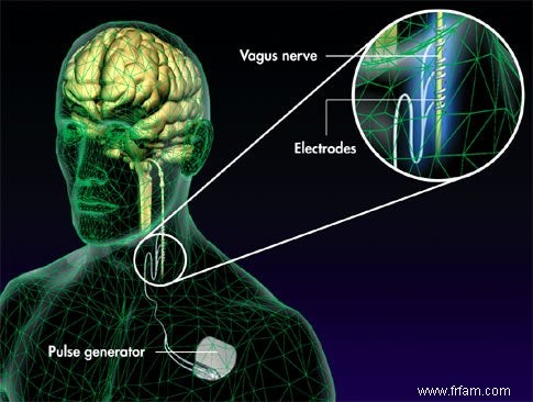 Stimulateur cérébral 
