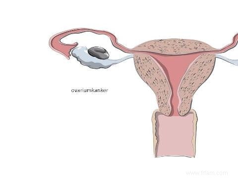 Le cancer de l ovaire ne prend pas naissance dans les ovaires 