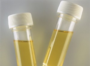 L urine contient des traces précoces de lésions hépatiques 