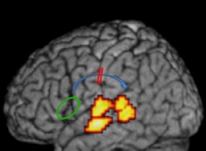 Les connexions cérébrales perturbées provoquent la dyslexie 