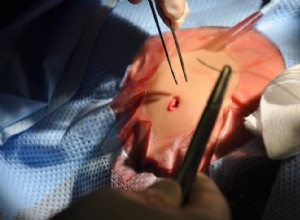 Des médecins de Louvain placent une valve cardiaque chez un bébé 