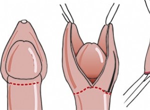 La circoncision masculine est-elle la voie vers une Afrique sans sida ? 