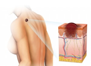 L ADN de l encombrement joue un rôle dans le cancer de la peau 