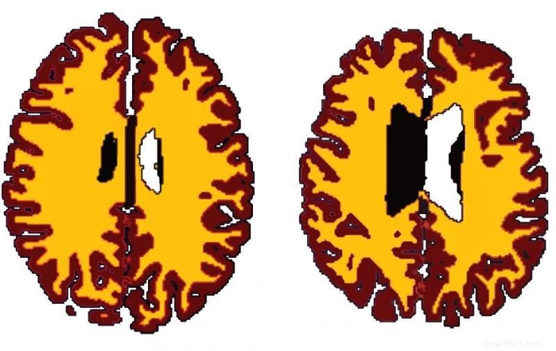 Les personnes obèses ont un cerveau plus âgé 