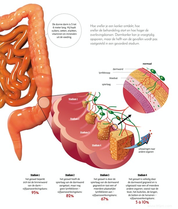 5 questions sur le cancer du côlon 