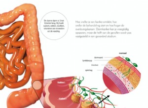 5 questions sur le cancer du côlon 