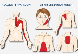 Comment savez-vous que vous faites une crise cardiaque? 