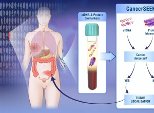 Un simple test sanguin détecte huit cancers courants à un stade précoce 