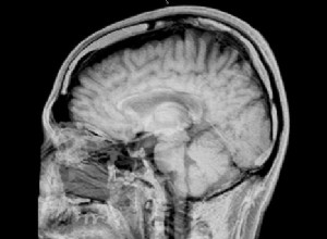 Les erreurs génétiques annoncent la schizophrénie 