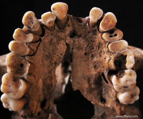 Les noix ont donné aux chasseurs-cueilleurs des dents pourries 