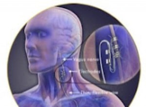 Neurostimulateur intelligent implanté contre l épilepsie 