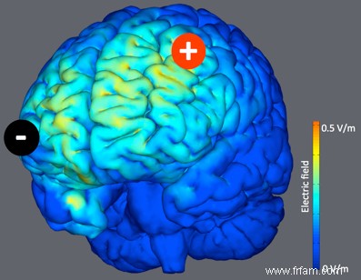 L électrostimulation  réveille  le cerveau des patients dans le coma 