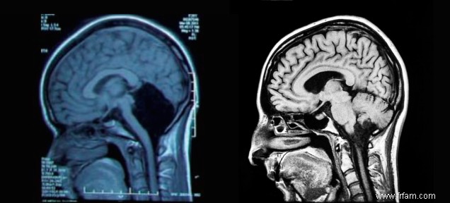 La vie sans petit cerveau 