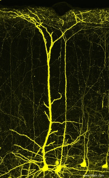 Jeune cerveau après un AVC ? 