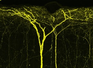 Jeune cerveau après un AVC ? 