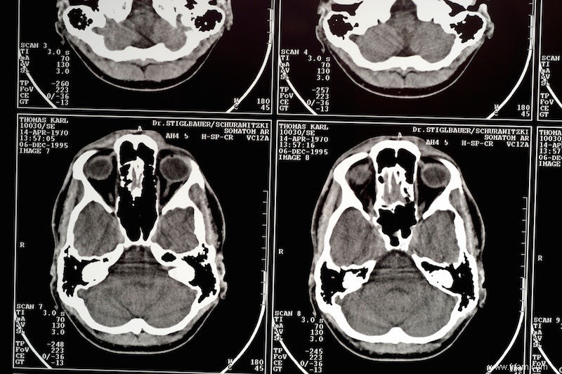 Que font les variations génétiques sur notre cerveau ? 