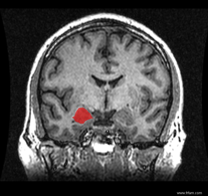 Comment le cerveau nous fait peur 