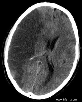 Moins de dégâts après un infarctus cérébral 