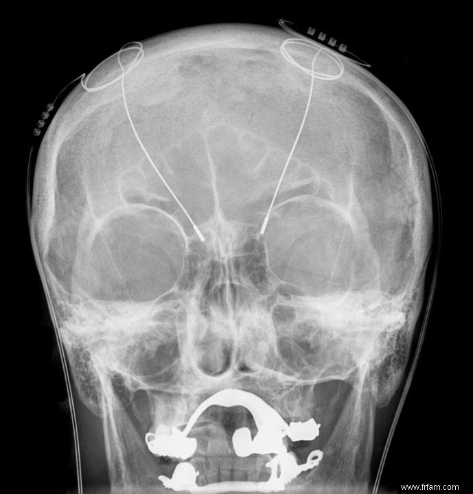 Une puce cérébrale déconnecte les zones cérébrales des patients atteints de la maladie de Parkinson 