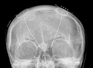 Une puce cérébrale déconnecte les zones cérébrales des patients atteints de la maladie de Parkinson 