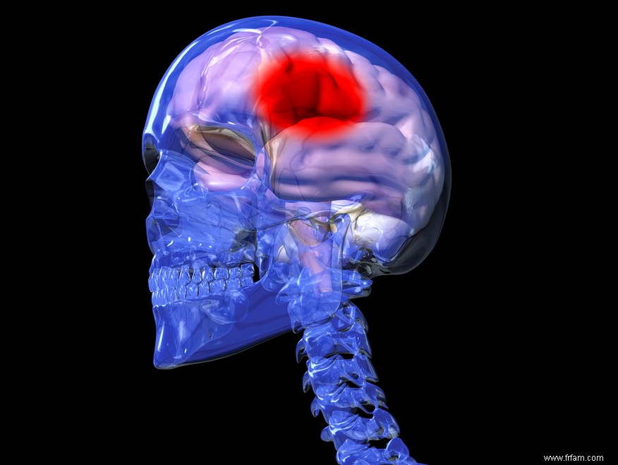 Nouvelle stratégie contre l infarctus cérébral 