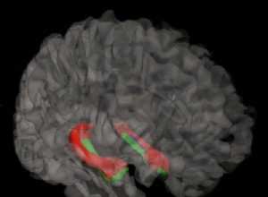 Le rétrécissement de l hippocampe indique la maladie d Alzheimer 