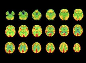 L IRM aide à détecter la maladie d Alzheimer 