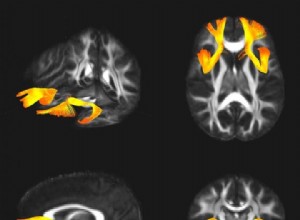 Le même gène cause la schizophrénie et le trouble bipolaire 