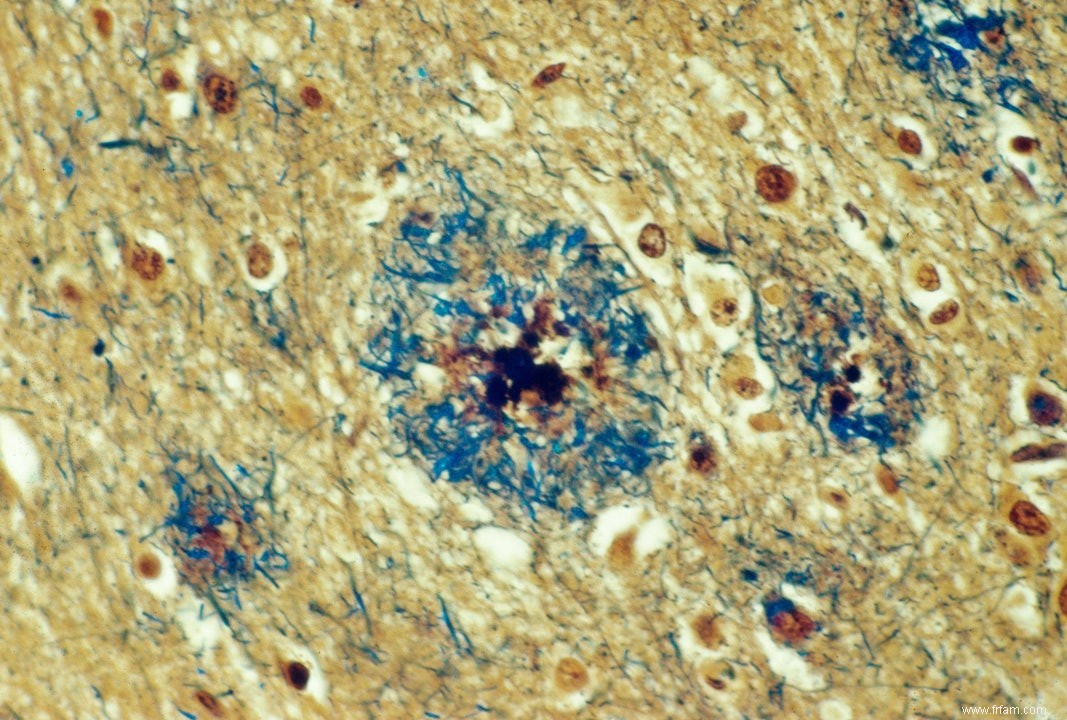 L inflammation peut stimuler la maladie d Alzheimer 