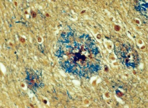 L inflammation peut stimuler la maladie d Alzheimer 