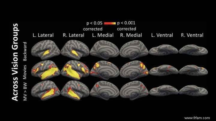 Les personnes aveugles utilisent le cortex visuel pour écouter 