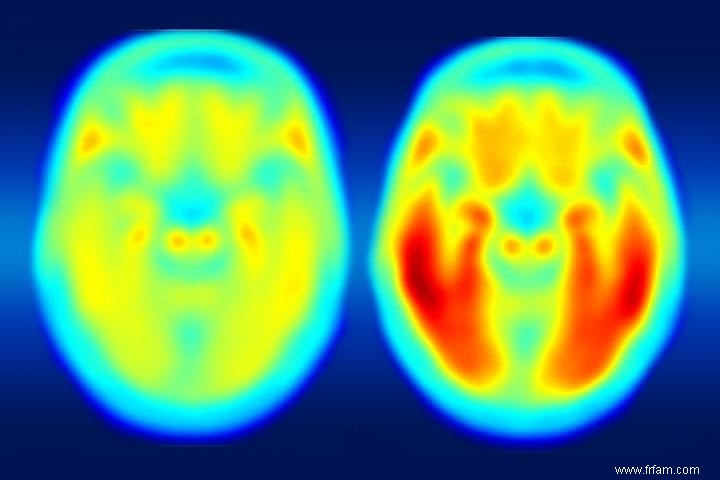 Une thérapie expérimentale s attaque à la maladie d Alzheimer avec la lumière et le son 