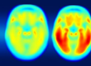 Une thérapie expérimentale s attaque à la maladie d Alzheimer avec la lumière et le son 