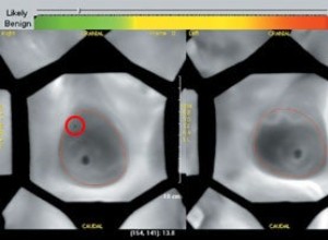 Nouvelle façon de détecter le cancer du sein 