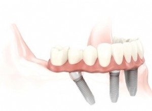 Différents types d implants dentaires et comment en choisir un en fonction de la santé de votre mâchoire 