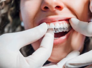 Questions sur Invisalign :leur coût, leur processus, etc. 